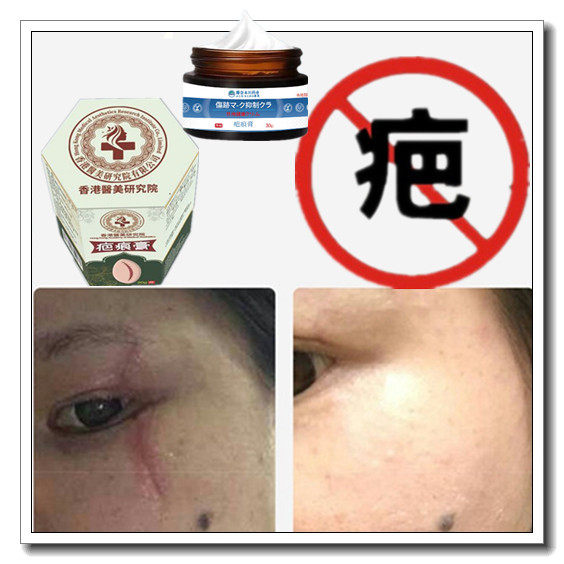 去疙瘩烟烫增生性凸疤手术剖腹产伤疤痕印体质缝针沉着色素修复膏