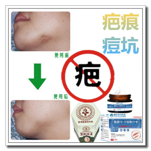 祛修复增生性凸疤手术药膏伤疤痕印黑印抓痕淡化黑色素沉着回流液