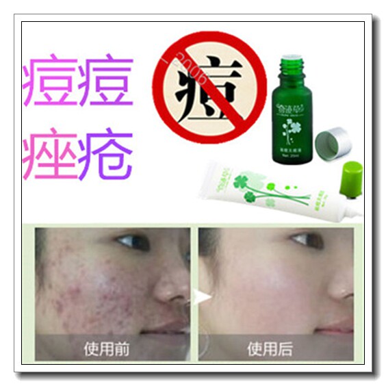 专业祛黑头酒糟鼻消去闭口粉刺脂肪粒痘痘除螨虫脸部清洁药膏神器