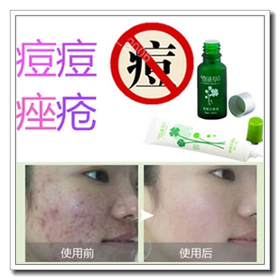 专业祛黑头酒糟鼻消去闭口粉刺脂肪粒痘痘除螨虫脸部清洁药膏神器
