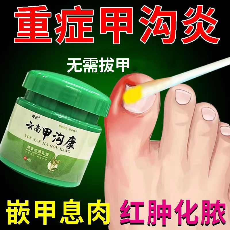甲沟炎脚趾甲往肉里长正品肿去肉芽嵌甲化脓息肉去除膏