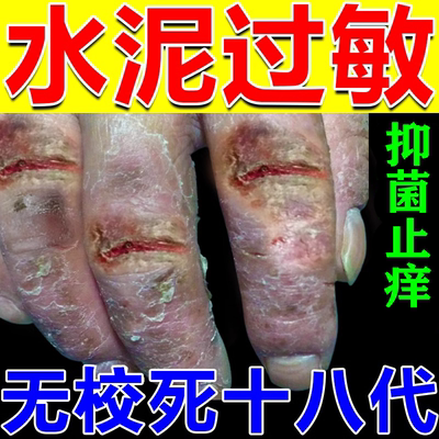 100%止痒治水泥过敏【工友推荐】