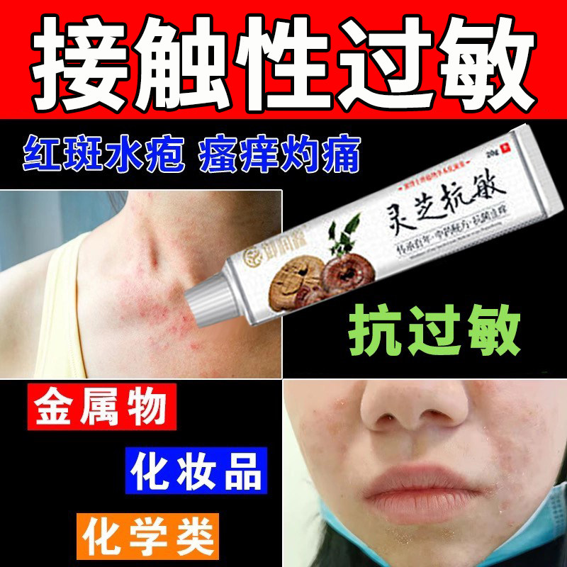 接触性皮肤过敏金属过敏化学品接触皮肤红肿水泡丘疹瘙痒抗过敏膏