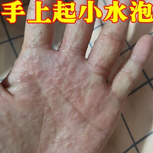 手癣手脱皮干裂汗泡 疹足鹅掌手上起小水 泡手痒风真菌感染瘙痒膏