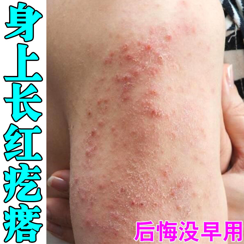 身上起红点痒治【疗皮肤的药身上痒一抓就起泡身上红血点止痒软膏,保健用品,皮肤消毒护理（消）,淘宝优惠券,粉丝福利购,淘宝优惠卷