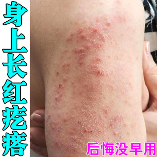 身上起红点痒治【疗皮肤的药身上痒一抓就起泡身上红血点止痒软膏