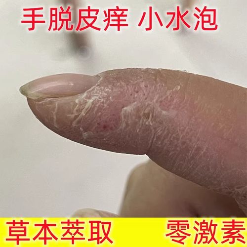 手上起小水泡汗状疱疹止痒汉状感染真菌鹅掌风干裂脱皮止痒抑菌膏