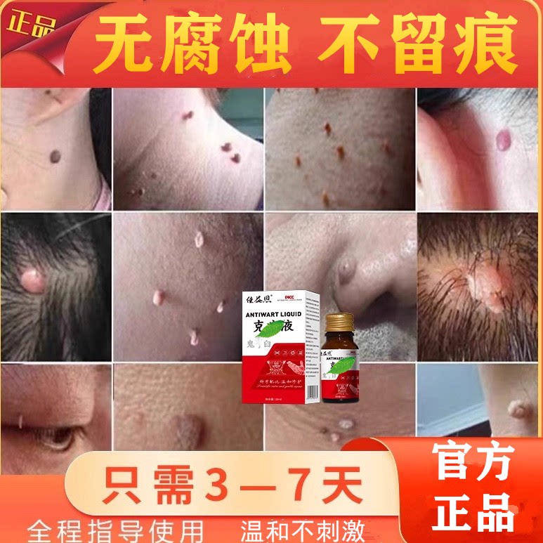 脖子上小肉球肉粒肉刺疙瘩赘肉丝状疣瘊子去除神器腋下疣一抹无忧