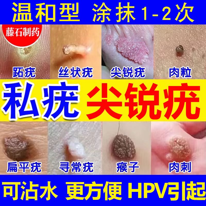 血胞刺血泡刺贴跖疣刺猴肉疣瘊子老鼠鱼鳞痣专用非祛去除膏神器根