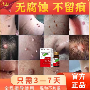 跖疣专用膏药去脚底趾疣根日本肉刺鸡眼去除神器疣瘊肉粒一抹无忧