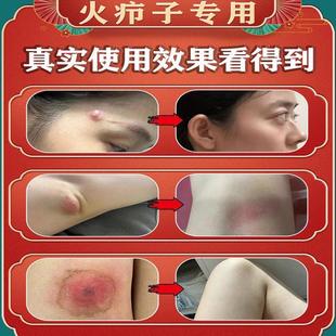 火疖子药膏19342艮治红肿脓包拔吸脓屁股硬块大包痘疖子毒外用抑