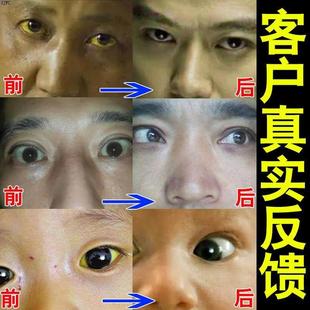 专眼白MSV发黄浊有血红丝去黄变白一滴除中草攻眼浑药水眼白去黄