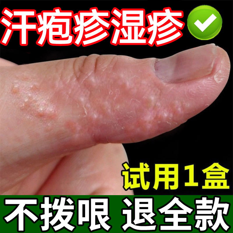 【手上小水泡】汗疱疹专用抑菌膏