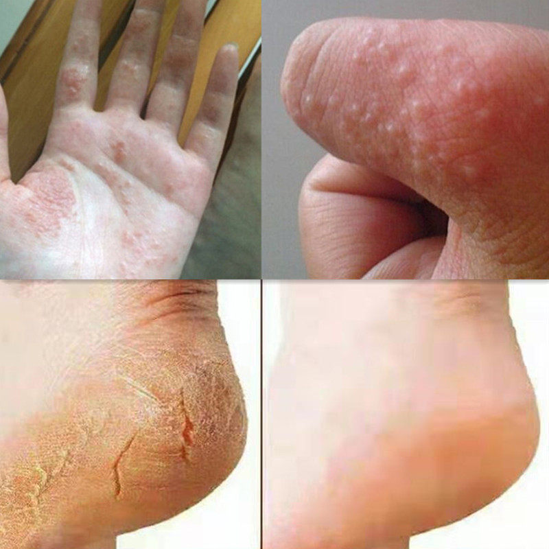 手掌手指脚手掉皮脚底干燥脱皮起皮蜕皮爆皮褪皮退皮膏滋养修复