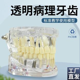 牙科修复模型口腔科病理s医患沟通教学修复体综合带神经可拆卸牙