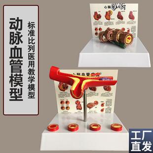 人体支脉粥样形成模型血管模型E血液科动脉模型教学血管模型