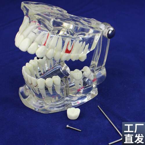 ENOVO正品牙齿模型口腔牙齿A科疾病种植修复模型口腔病理模型
