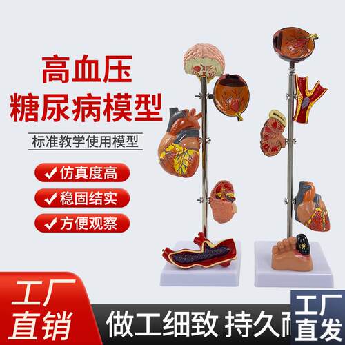 医学糖尿病病理模型心脏模型肾脏模型眼J模型糖尿病足糖尿病模型