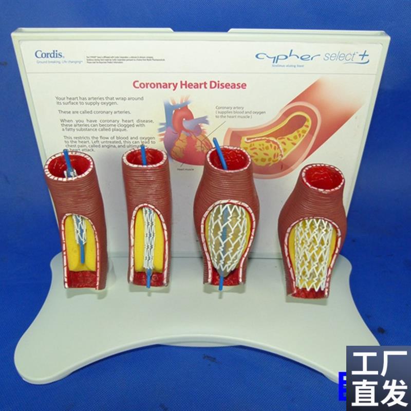 人体血管堵塞支h架模型人体心脑血管堵塞教学模型人体支架解剖模