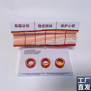 病理心血管模型粥样硬化脂w肪斑块动脉内膜受损程度医药促销礼品