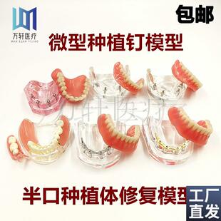 牙科口腔教学模型种植修复对比模型微型种植钉N2颗4颗钉种植球帽