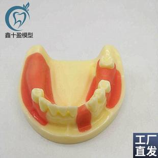 不同牙位缺失种植练习模型可练习切开种J植缝合有仿骨质结构硅胶