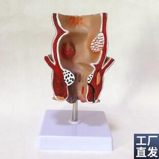 人体结肠模型大j肠标识病理肠道突出肉扭转老人盲肠阑尾直肠肛周