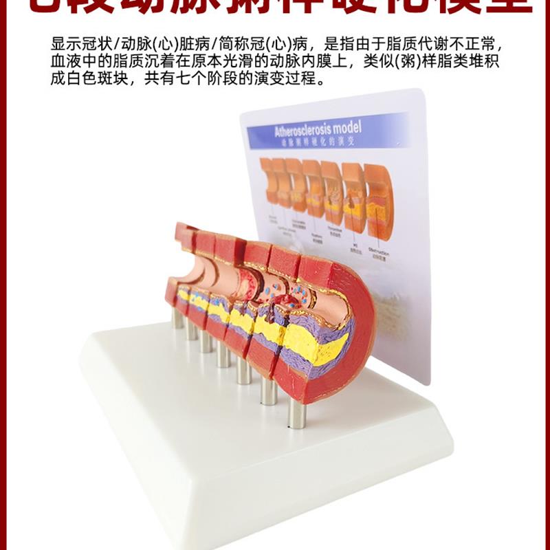 人体心脑血管动脉粥样硬化堵塞模型血栓血液脂肪病理解剖医学教具