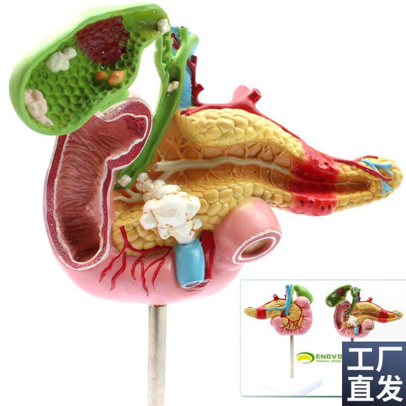 ENOVO颐诺医学胰腺十二指肠胆A囊病理模型胆结石外科消化系统模型