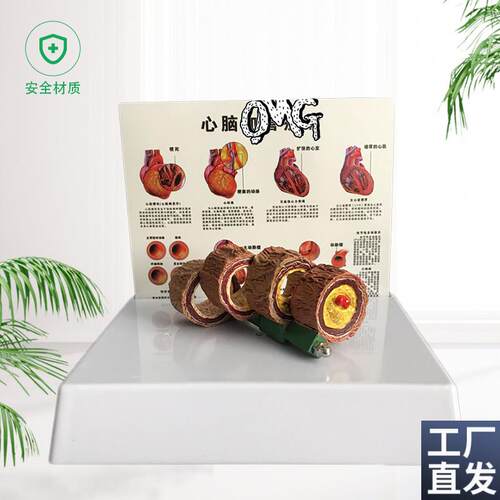 教学仿真血管模h型活动血管阻塞模型血栓病变标本4阶段性动脉O硬