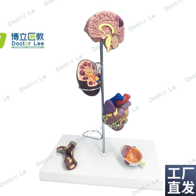 人体高血压模型高血压大脑心脏血管内K科普外科医生礼品大脑