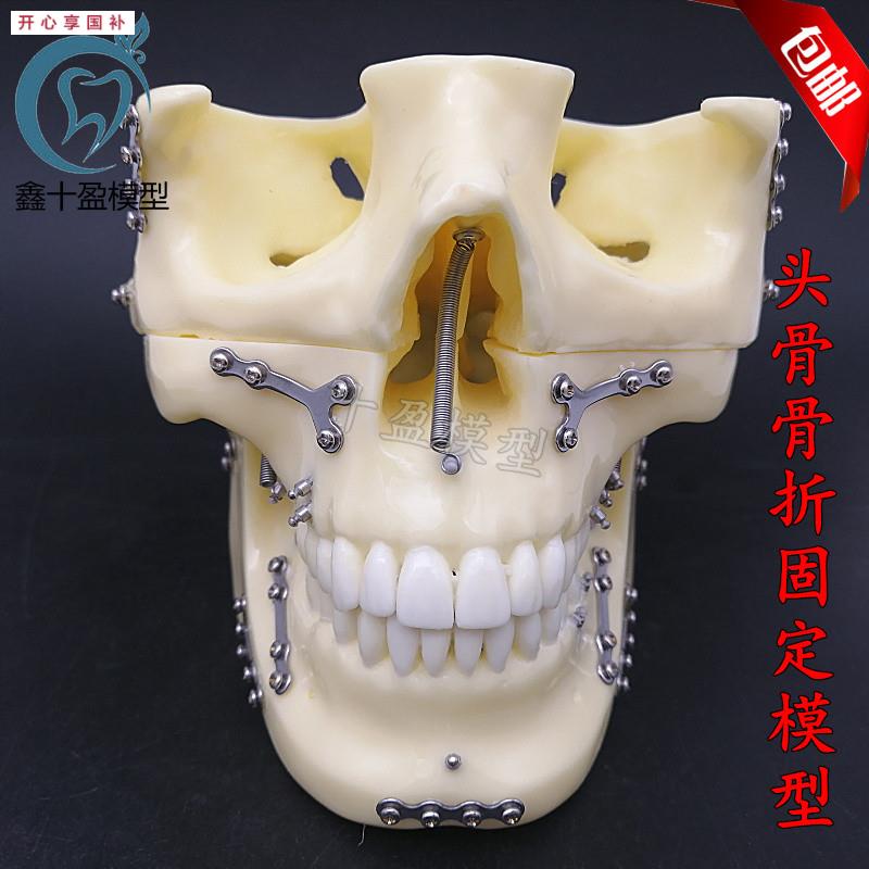 牙科种植支抗钉模型头颅V骨折固定模型头颅骨口腔模型医学教学