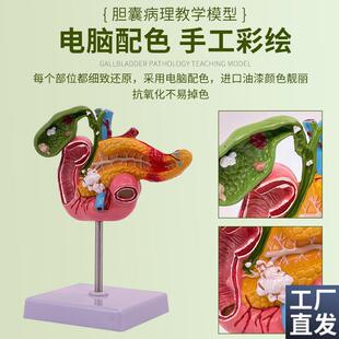 仿真病变胰腺十二指肠胆囊病理模型消化系统肝脏S胰脾肠道标本教