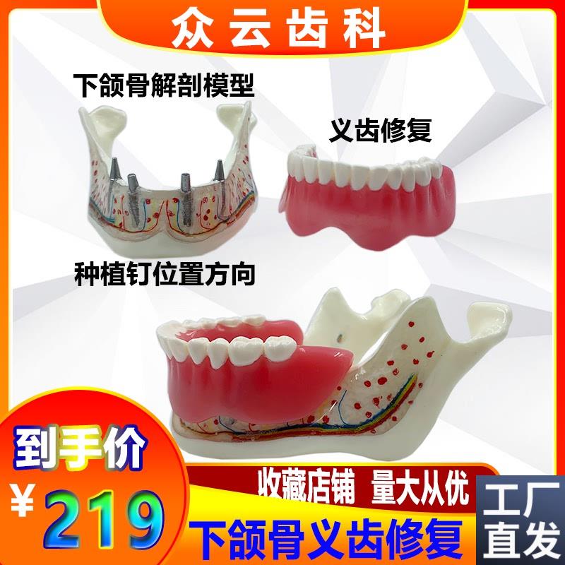 牙科口腔下颌骨神经义齿修复覆盖模D型可拆卸医患沟通讲解模型包