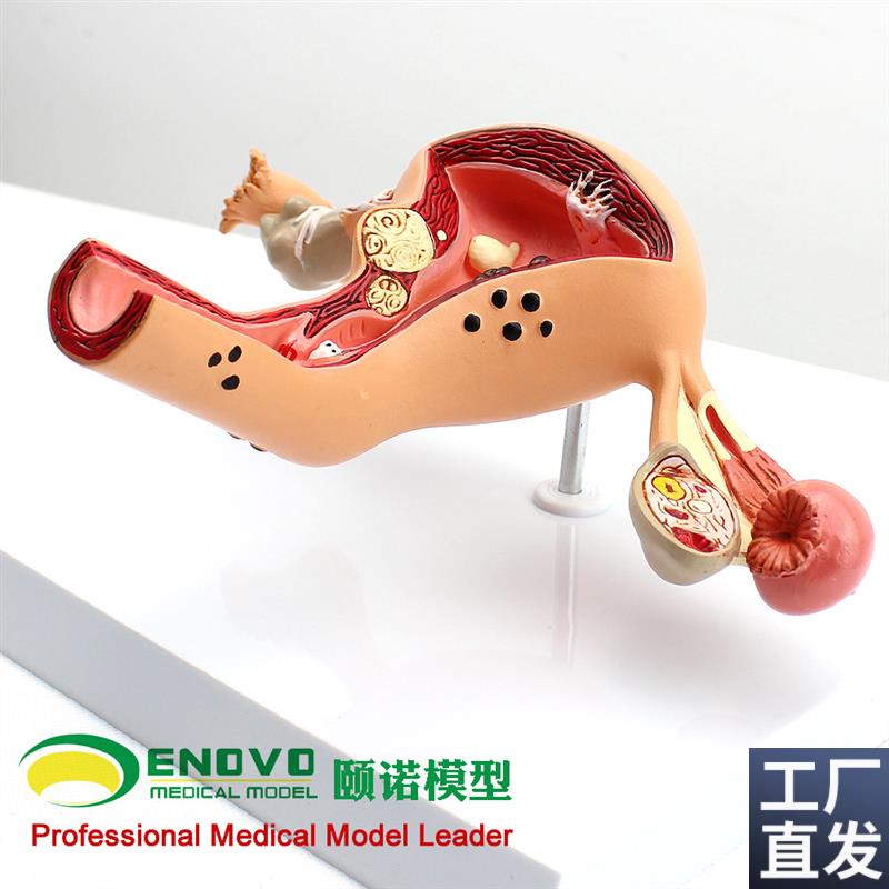 颐诺正品人体子宫卵巢阴道疾病D模型生殖科妇科医用医患模型