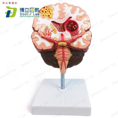 人体脑解剖脑病理疾病脑病g理构造脑(血管)病变脑模型