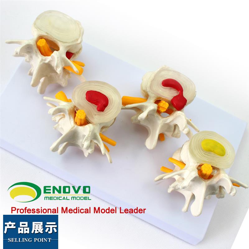 ENOVO颐诺医学人体腰椎模型  椎体椎间盘病变髓核膨出脱出软骨板