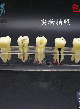 口腔教学模具水晶根管治疗模型可拆修复牙J冠龋齿蛀牙病理M4012