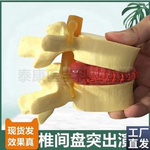 人体腰椎模型椎间盘脊髓神经椎B骨劳损病理突出演示疏松骨密质