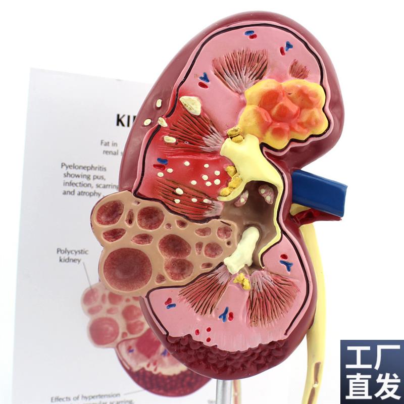 ENOVO颐诺医学人体肾脏解w剖模型肾炎肾部模型肾脏病理泌尿外科男