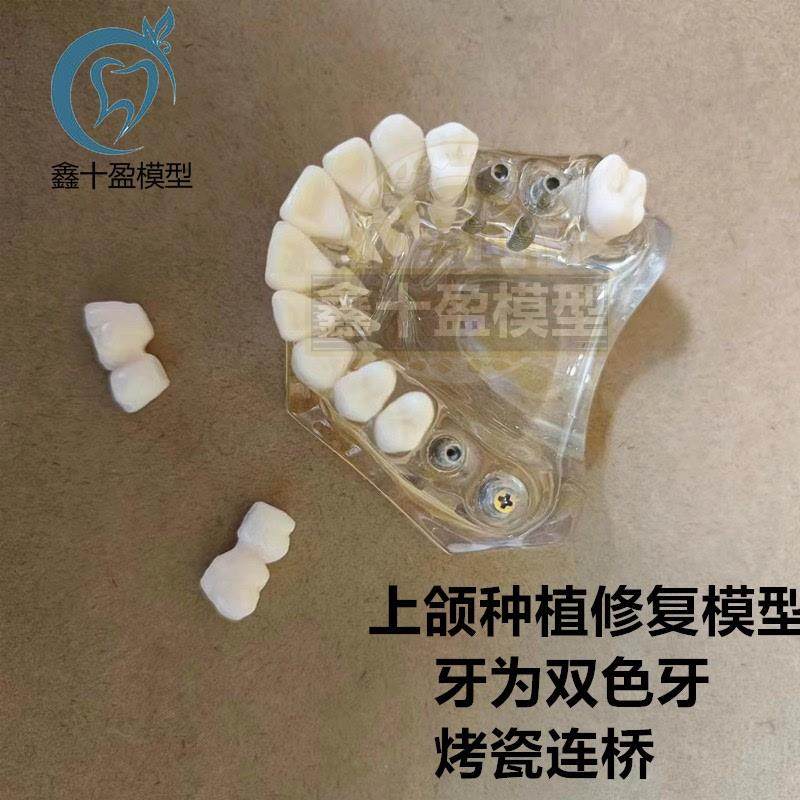 牙科种植模型2011 上颌种植解说义齿修复 烤瓷连桥 种植钉模型
