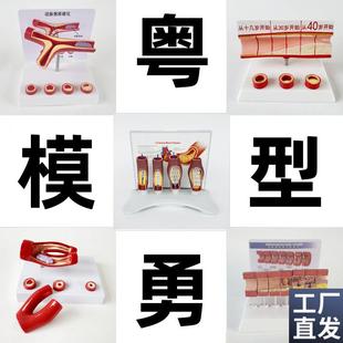 动态血管粘稠堵j塞模型动支脉粥样硬化心血管支架放大病理教学模
