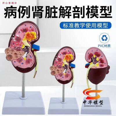 教学人体肾脏病变模型泌尿科肾模型肾小球肾单位肾w脏解剖模型
