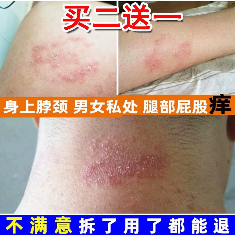 运动出汗皮肤痒起鸡皮疙瘩(运动后皮肤发痒起疙瘩怎么办) 运动出汗皮肤痒起鸡皮疙瘩(运动后皮肤发痒起疙瘩怎么办)