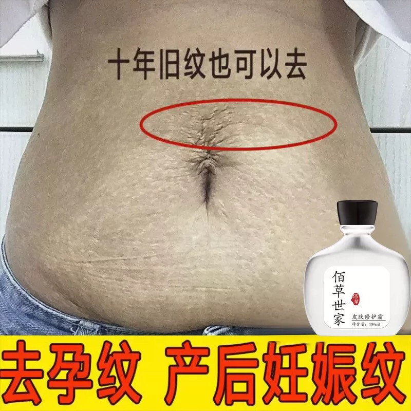 正品祛妊娠纹修复霜产后肚子大腿妊娠纹护理