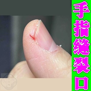 手指头裂口子干裂修复霜秋冬季指甲缝开裂脱皮疼痛防皲裂愈合药膏