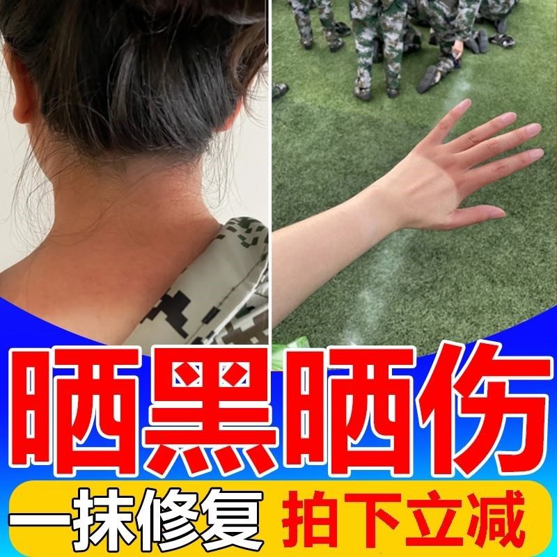 晒黑了修复快速变白皮肤晒伤儿童晒后脸部脖子紫外线过敏军训专用