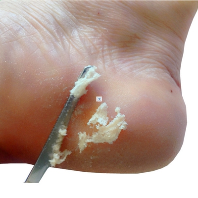Stainless Steel Foot Corn Remover Pedicure Knife Hand Foot C