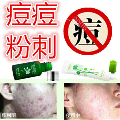 修复去除后背上痘痘正品痘印痘疤青春痘豆豆淡化疤痕黑头粉刺男女