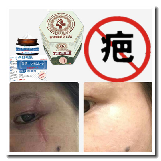 祛增生修复疙瘩性凸疤缝针剖宫产伤疤痕印激光手术抓伤色素沉着疤